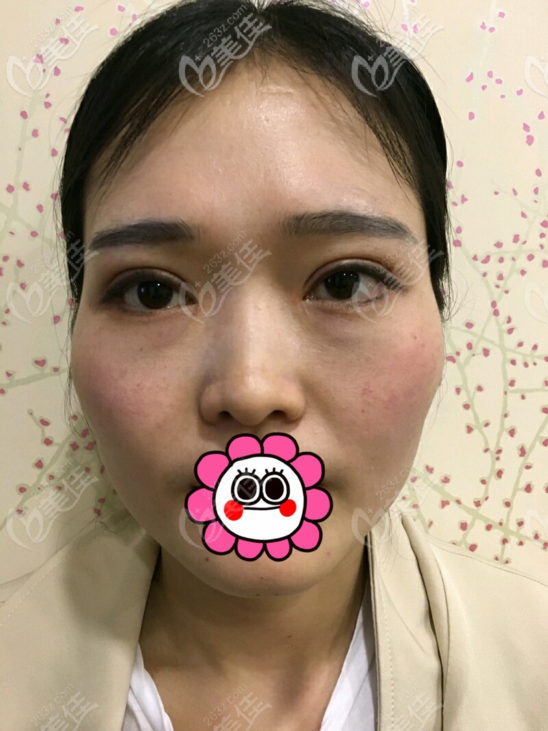 到杭州連天美做顴骨內(nèi)推前 到杭州連天美做顴骨內(nèi)推前