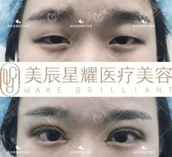 成都美辰星耀醫(yī)療美容院長江濤雙眼皮案例 成都美辰星耀醫(yī)療美容院長江濤雙眼皮案例