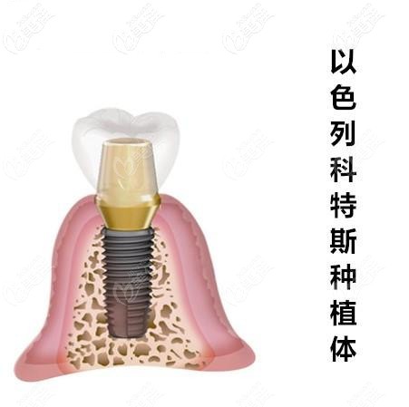 以色列科特斯cortex種植體