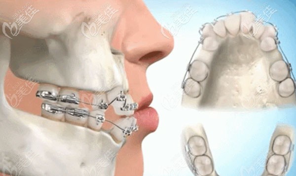 動(dòng)畫圖演示矯牙是如何改變臉型的 動(dòng)畫圖演示矯牙是如何改變臉型的