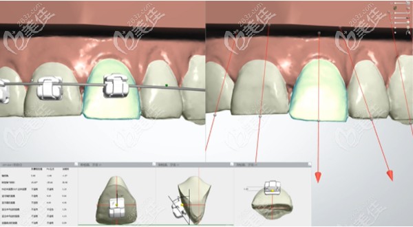 做二次矯正的注意點