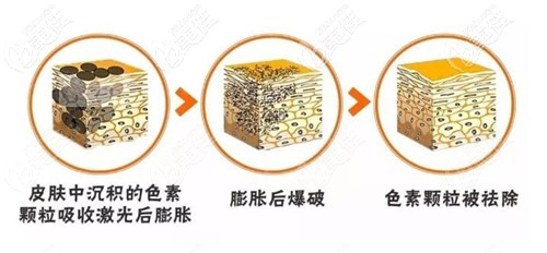激光祛斑的原理
