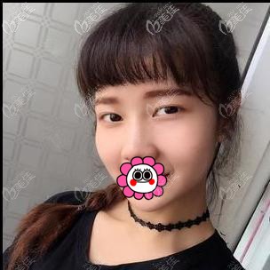 找郭光燁做雙眼皮前 找郭光燁做雙眼皮前