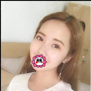 寧波郭光燁做雙眼皮手術(shù)怎么樣？看我花了近五千元的效果如何