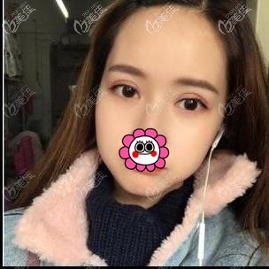 雙眼皮7天拆線后 雙眼皮7天拆線后