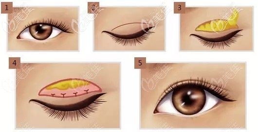 劉從盛醫(yī)生做雙眼皮手術(shù)過程 劉從盛醫(yī)生做雙眼皮手術(shù)過程