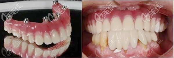 allon6種植技術(shù)案例 allon6種植技術(shù)案例