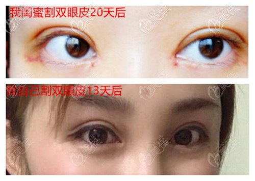 吃消脫止后的效果