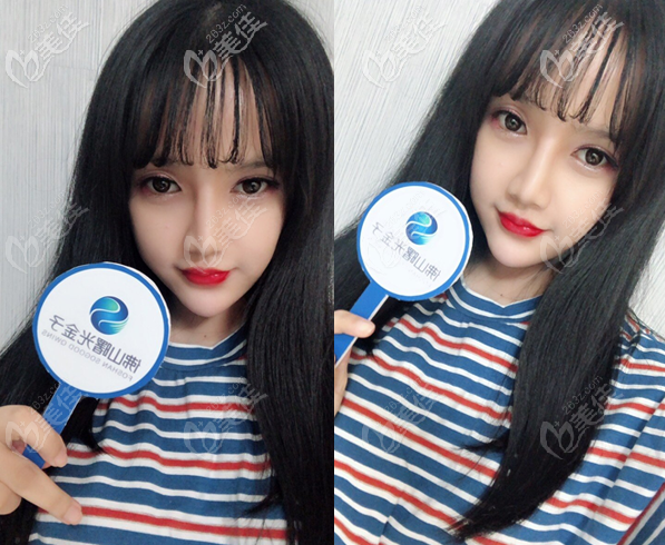 廣州劉云忠鼻子案例 廣州劉云忠鼻子案例