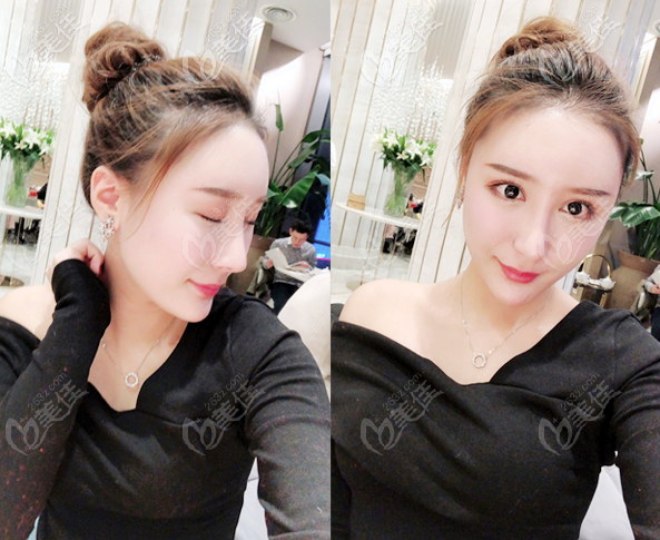 劉云忠醫(yī)生做鼻子怎么樣?鼻整形案例好看價格還不貴