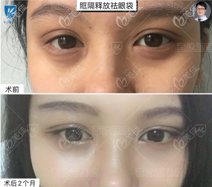 重慶百達麗別箏醫(yī)生眶隔釋放去眼袋效果圖