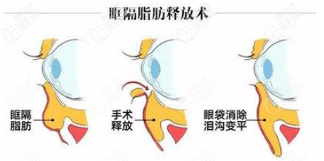 眶隔脂肪釋放祛眼袋填淚溝手術(shù)