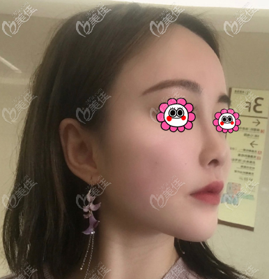 杜寧醫(yī)生面部吸脂案例 杜寧醫(yī)生面部吸脂案例