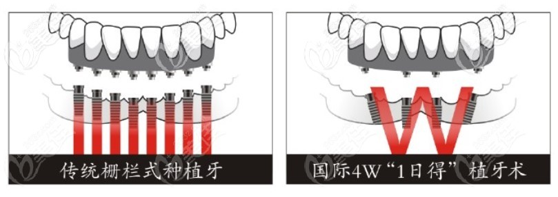 網(wǎng)上找的傳統(tǒng)柵欄式種植牙和allon4種植牙對(duì)比圖