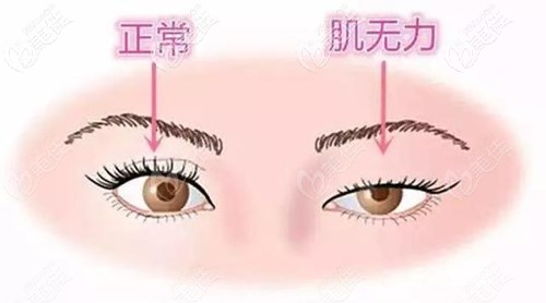 雙眼皮和上下下垂的區(qū)別