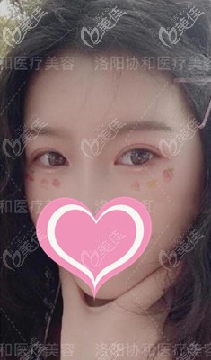 輕度上瞼下垂找馬冠楠割雙眼皮的同時還做了提肌,這區(qū)別還真蠻大的
