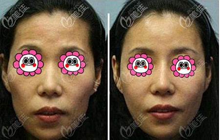 張讓虎脂肪填充全臉案例 張讓虎脂肪填充全臉案例