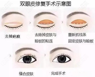 雙眼皮寬改窄修復(fù)過(guò)程 雙眼皮寬改窄修復(fù)過(guò)程
