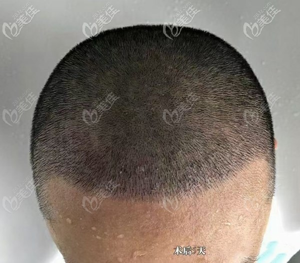 發(fā)際線種植術后第5天