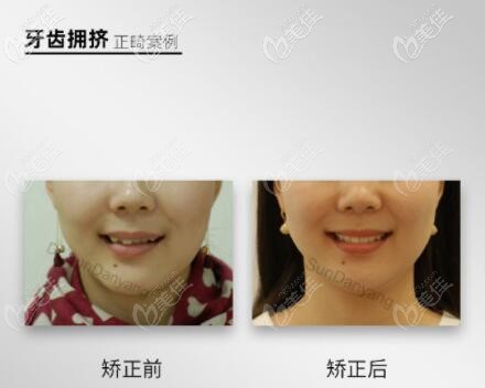 大連馬瀧齒科牙齒擁擠正畸案例前后對(duì)比照
