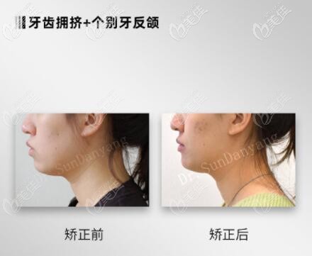 大連孫丹陽牙齒擁擠+個(gè)別牙反頜矯正真人前后對(duì)比照