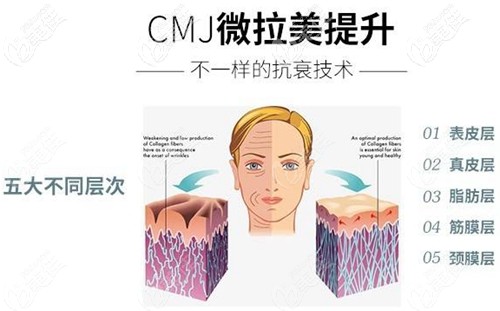 深圳曹孟君微拉美提升術(shù)