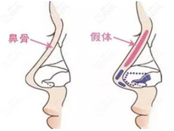 膨體隆鼻取出后多久能恢復(fù)到原樣