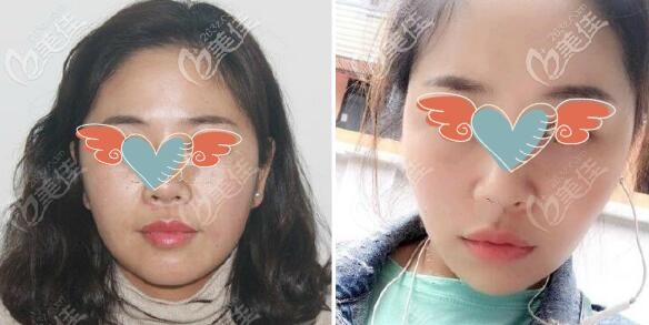 面部歐薇拉提升三個(gè)月效果圖片