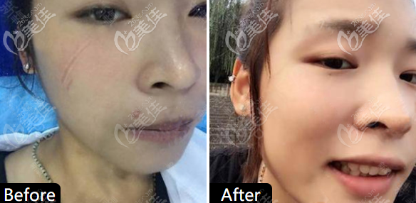 <!--<i data=20240703-sp></i>--><!--<i data=20240703-sp></i>-->激光祛斑