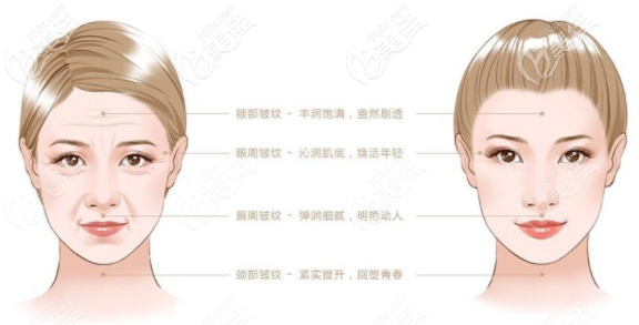 黃金射頻和深藍射頻哪個好？