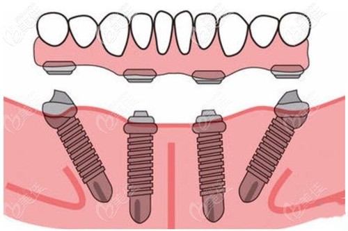牙齒種植效果 牙齒種植效果