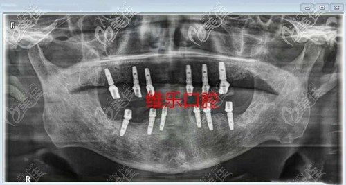 牙齒種植后的樣子 牙齒種植后的樣子