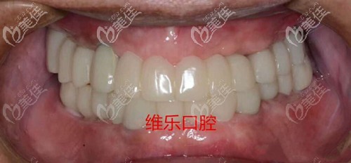 姥爺在洛陽(yáng)維樂(lè)做allon-6全口即刻負(fù)重種植牙后,見(jiàn)人都說(shuō)這錢花的真值