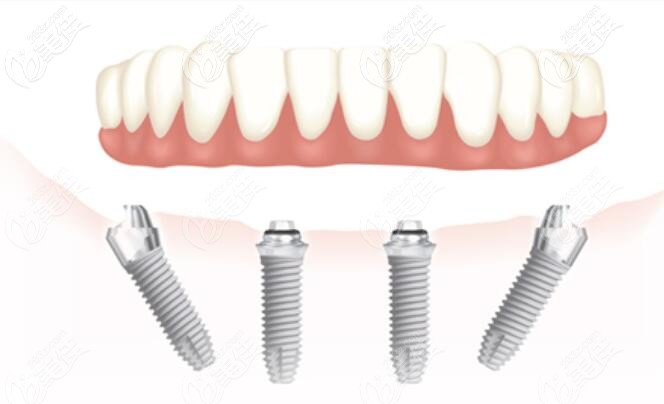 ALL-ON-4種植技術