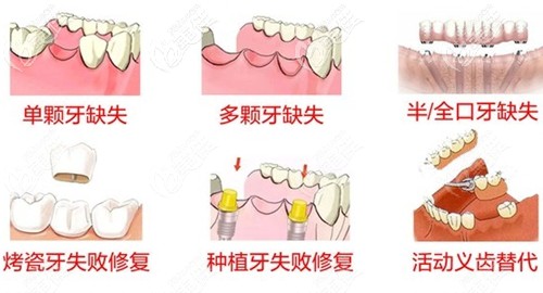 長春超龍牙博士種植牙適應情況