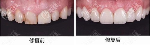 長春超龍牙博士全瓷牙貼面案例