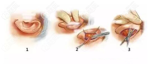 招風(fēng)耳手術(shù)過程 招風(fēng)耳手術(shù)過程