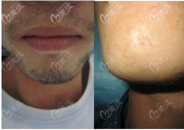 男士絡腮胡做月光真空脫毛案例效果圖片 男士絡腮胡做月光真空脫毛案例效果圖片