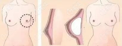 假體乳房再造示意圖 假體乳房再造示意圖