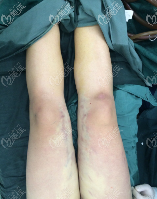 O型腿矯正術(shù)后即刻照 O型腿矯正術(shù)后即刻照