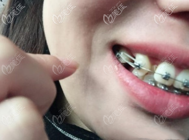 關(guān)閉牙齒間隙