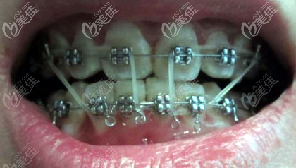 調(diào)整前牙深覆合