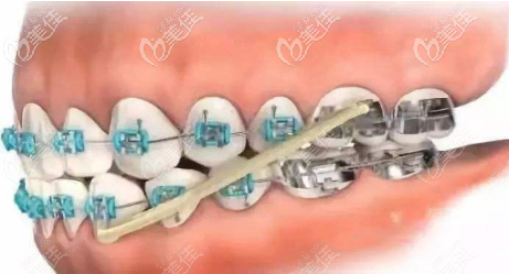 調(diào)整后牙的咬合關(guān)系