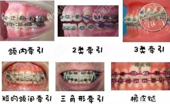 正畸牙套橡皮圈掛法示意圖