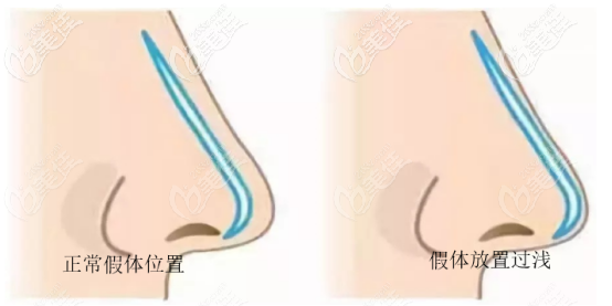 硅膠隆鼻假體應該防止的位置