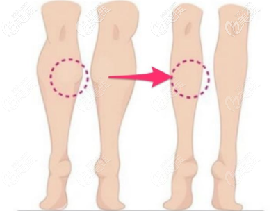 肌肉型小腿粗壯 肌肉型小腿粗壯