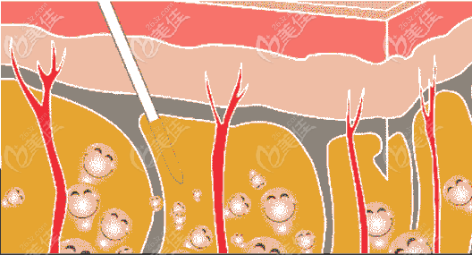 大腿吸脂手術原理 大腿吸脂手術原理