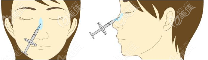 玻尿酸隆鼻和注射植骨隆鼻哪個維持時間久