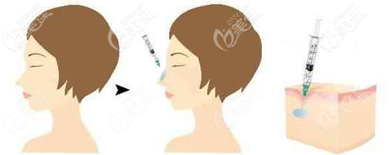 玻尿酸隆鼻和注射植骨隆鼻