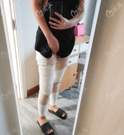 術(shù)后第4天 術(shù)后第4天